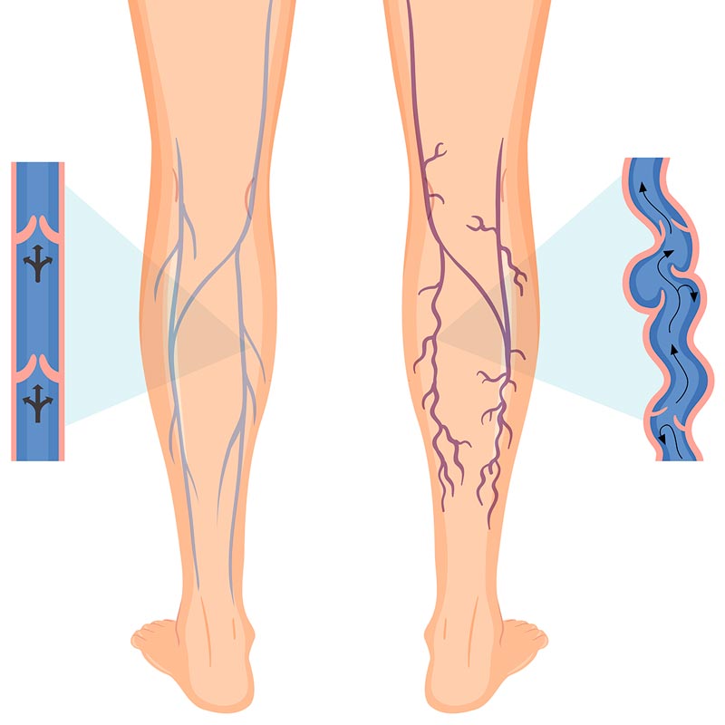 Tratamento de varizes